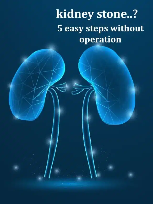 Kidney Stone: Relief in 5 Easy steps without Operations