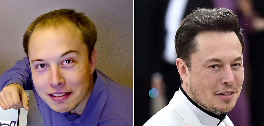 Hair Transplant Elon_Musk-transformed