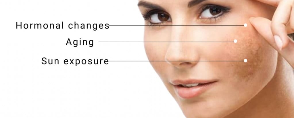 cure melasma