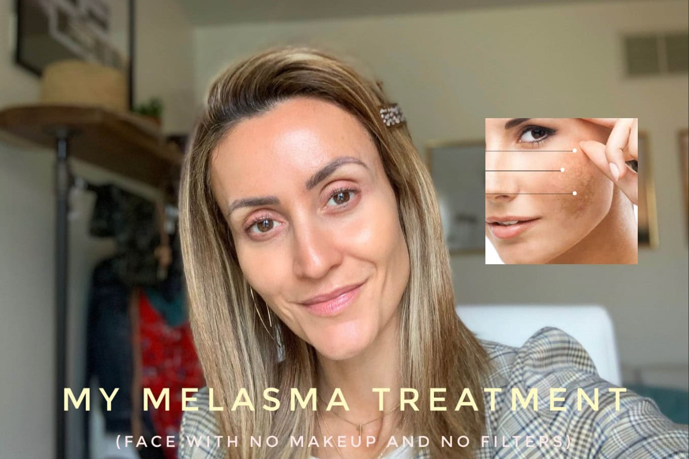 cure melasma